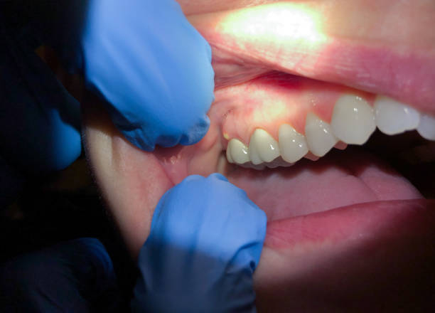 Best Emergency Dental Care for Broken or Chipped Teeth in Kettering, OH
